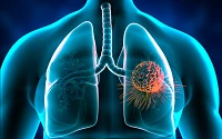 Lungenkrebs vorbeugen und erkennen