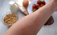 Lebensmittelallergien  – das kann gefährlich werden