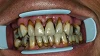 Die beste Option bei Zahnverlust: All-on-4 | BIZ Dr. Prinz