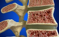 Osteoporose: Prävention und Behandlung